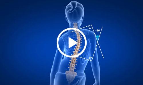 Adolescent Idiopathic Scoliosis