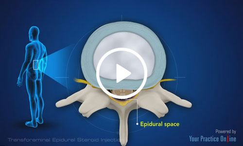 Epidural Steroid Injection 