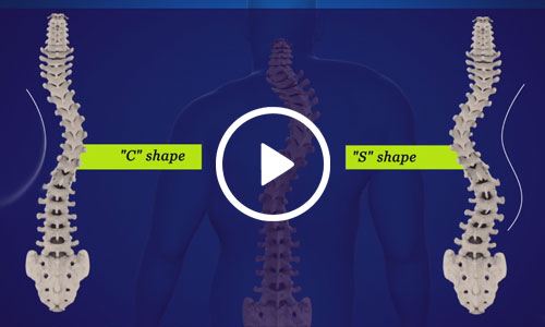 Scoliosis