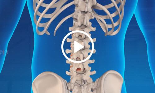 Spondyloarthropathy